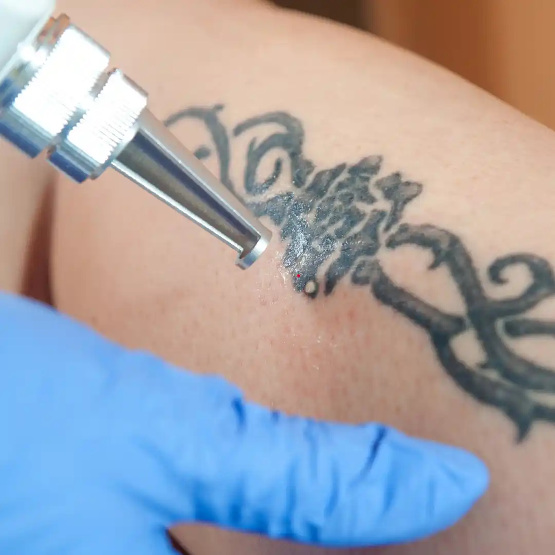 Laser Tattoo Removal In Gurgaon