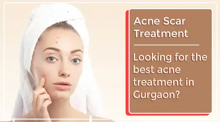 Acne Scar Treatment In Gurgaon