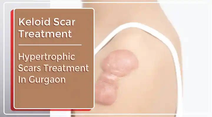 Keloid Treatment In Gurgaon